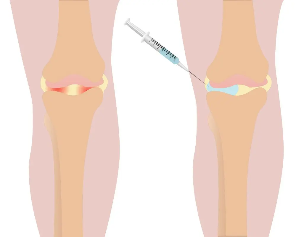 Knee or hip viscosupplementation, how does it work?