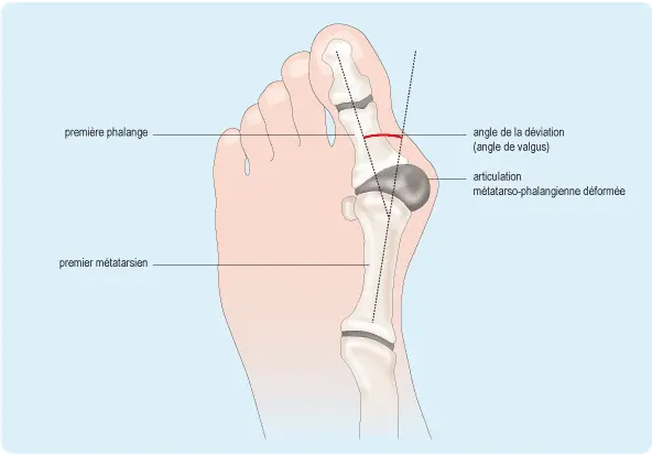 L &#8216;hallux valgus