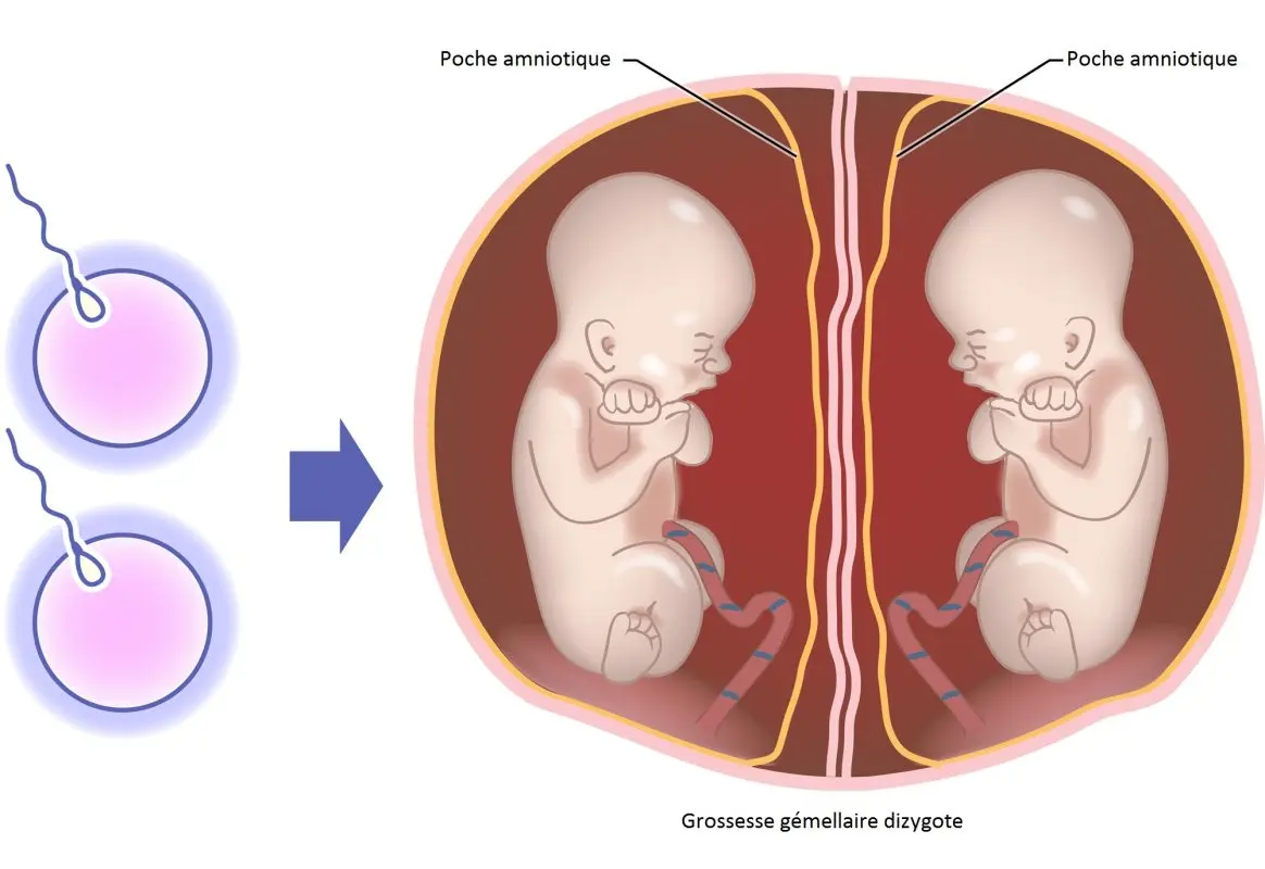 La grossesse gemellaire