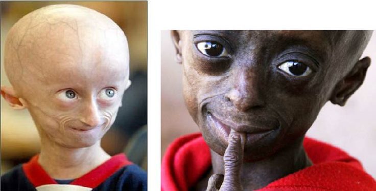 Progeria na Syndrome Hutchinson-Gilford
