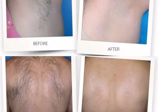Laser hair removal is the most effective