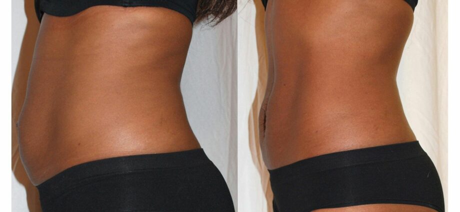 Laser lipolysis before and after photos