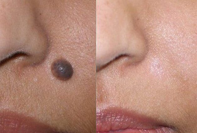 Laser removal of a mole