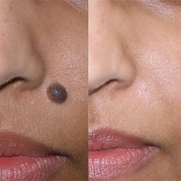 Laser removal of a mole