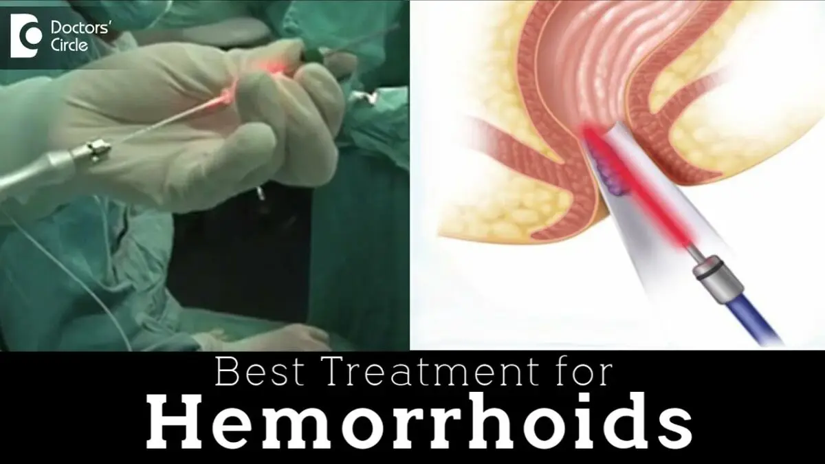 Laser treatment for hemorrhoids