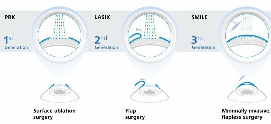 Laser vision correction: reviews