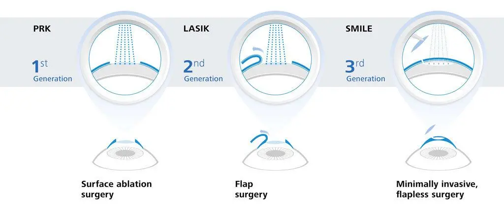 Laser vision correction: reviews