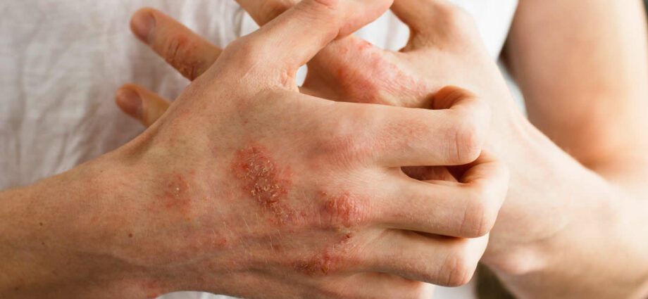 Alergija na lateks: simptomi in zdravljenje