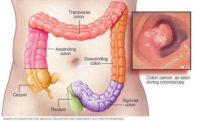 Le cancer du colon (cáncer colorrectal)