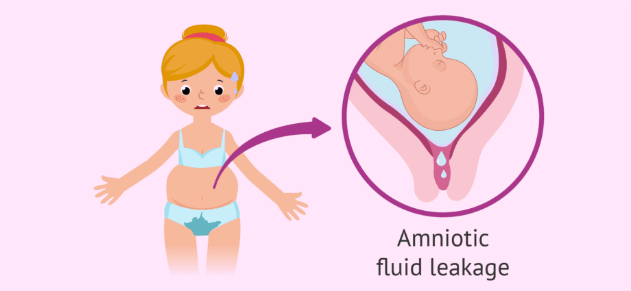 Leakage of water during pregnancy: how to determine the signs of leakage