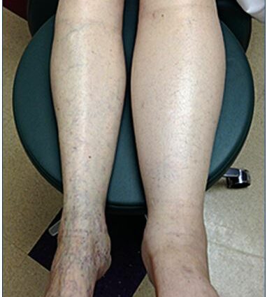 Leg edema &#8211; Sites of interest