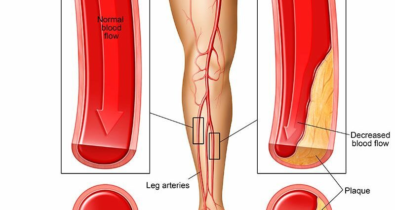 Leg hurts in the thigh, muscles: causes and methods of treatment