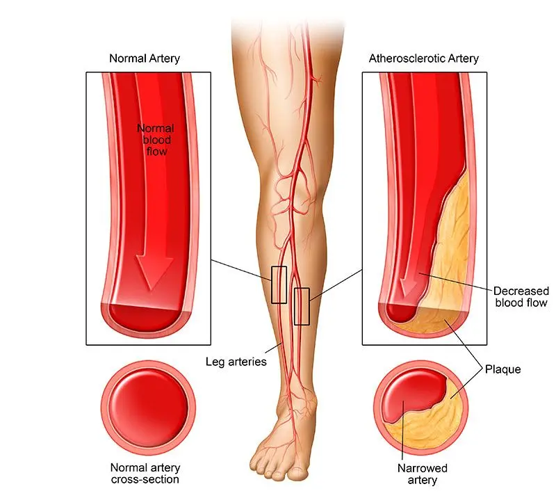 What to do if your legs hurt and swell after working at the computer