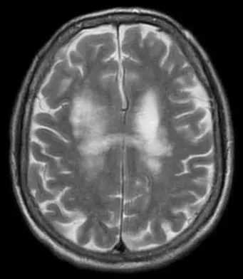 Lemp: what is progressive multifocal leukoencephalopathy?