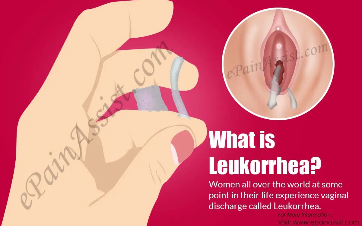 Leucorrhoea: understanding white discharge