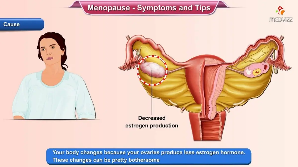 Menopause (menopause): symptoms and treatment. Video