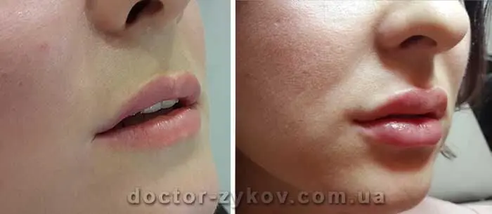 lip augmentation, lip correction, lip augmentation preparations