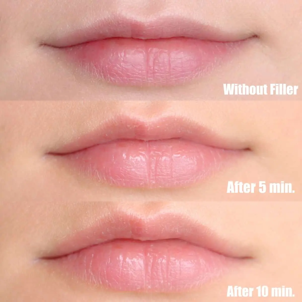 Lip augmentation with hyaluronic acid, reviews