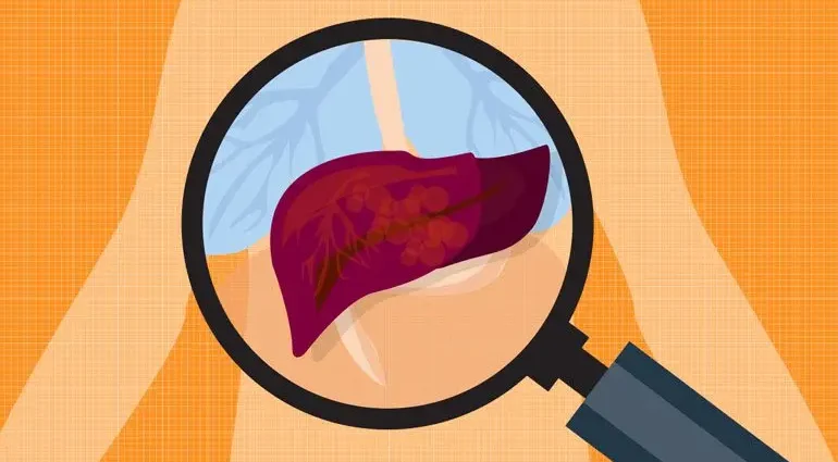 Liver attack: recognize the signs and treat them