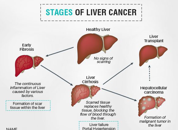 Rak jetre: definicija i simptomi