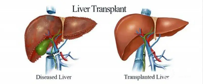 Liver transplant