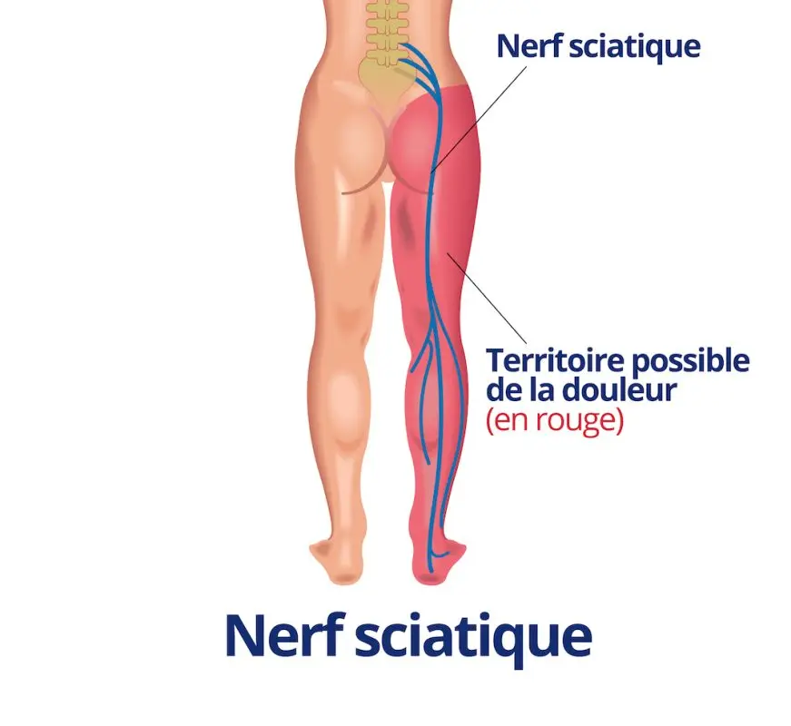 Lombosciatique