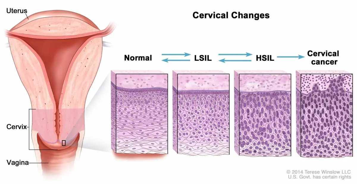 Low-grade squamous intraepithelial lesion