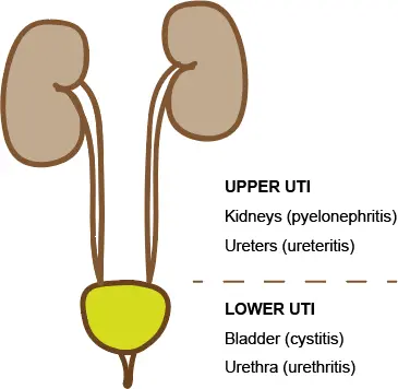 Lower urinary tract infection, or cystitis, in children