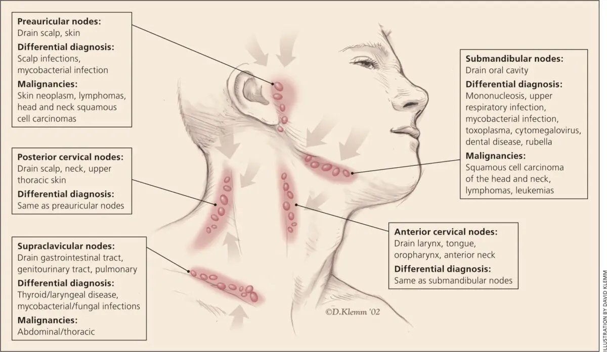 Lymph nodes in the neck: symptoms, diagnosis, treatment. Video