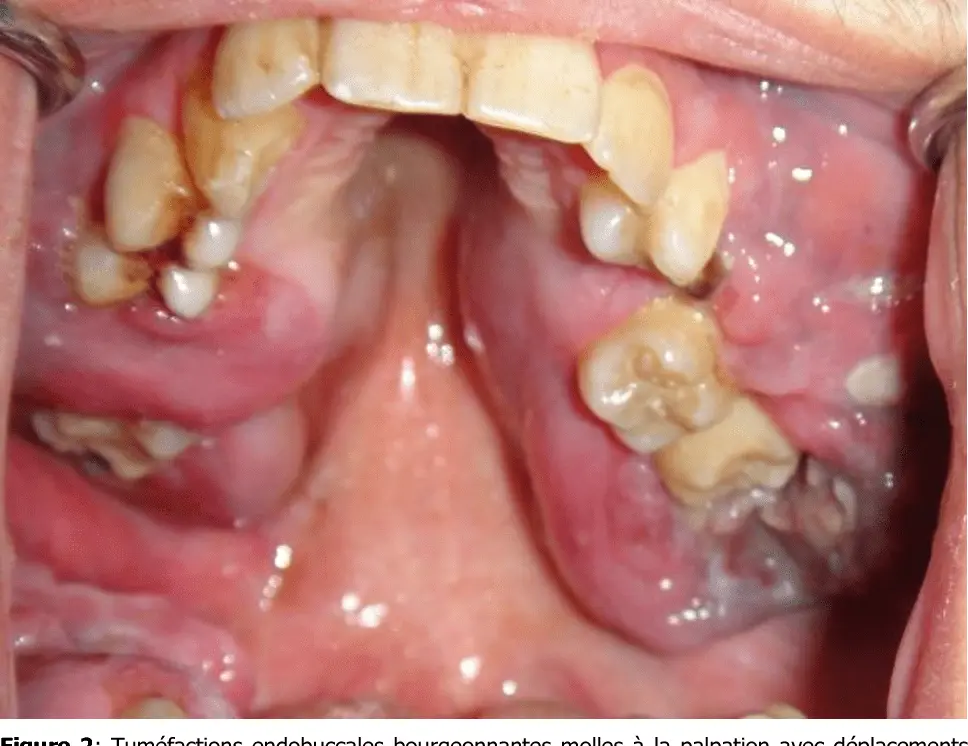 Lymphome de Burkitt