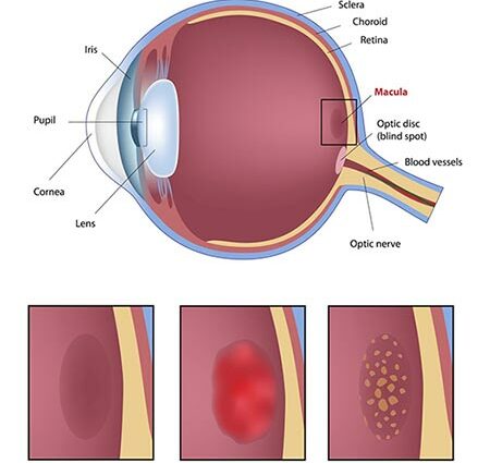 Macular degeneration &#8211; Our doctor&#8217;s opinion