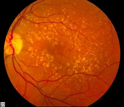 Macular degeneration