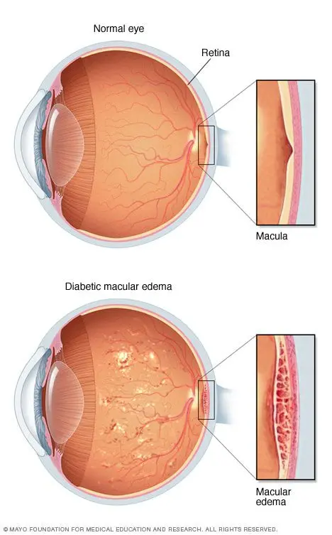 Macular edema