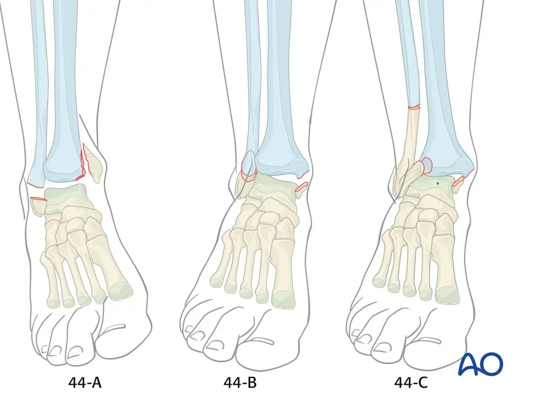 Malleolus: what to do in case of a fracture of the malleolus?