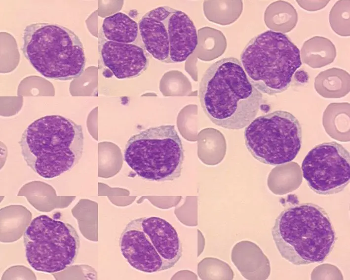 Mantle cell lymphoma