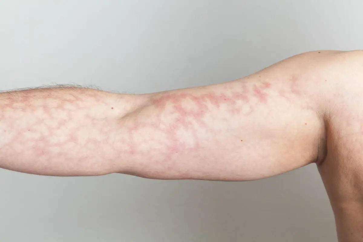 Marbled skin