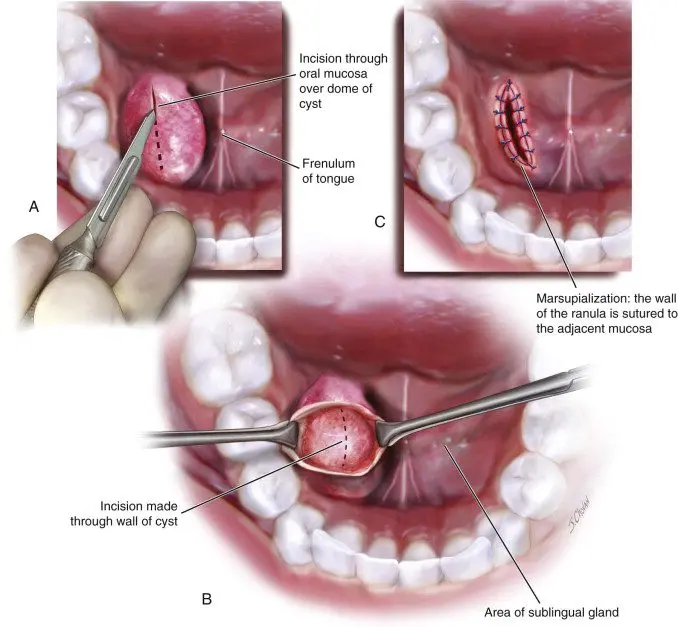 Marsupialization: all about this operation