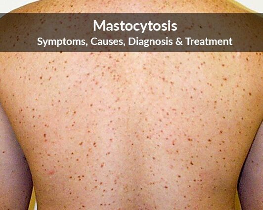 Mastocytosis, what is it?