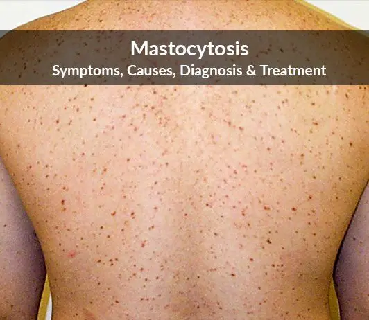 Mastocytosis, what is it?