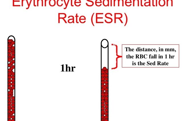 Mesura de la velocitat de sedimentació a la sang