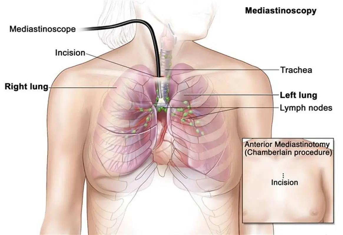 Mediastinoscopy: all about the examination of the mediastinum