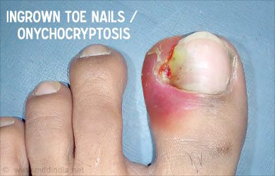 Medical treatments and complementary approaches to ingrown toenails