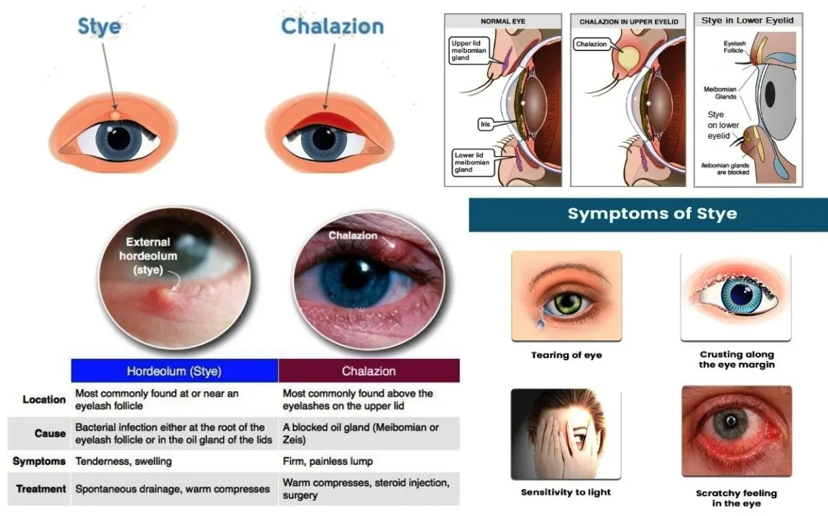 Medical treatments for a stye