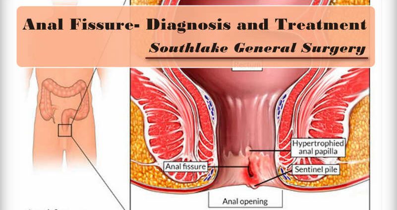 Medical treatments for anal fissure