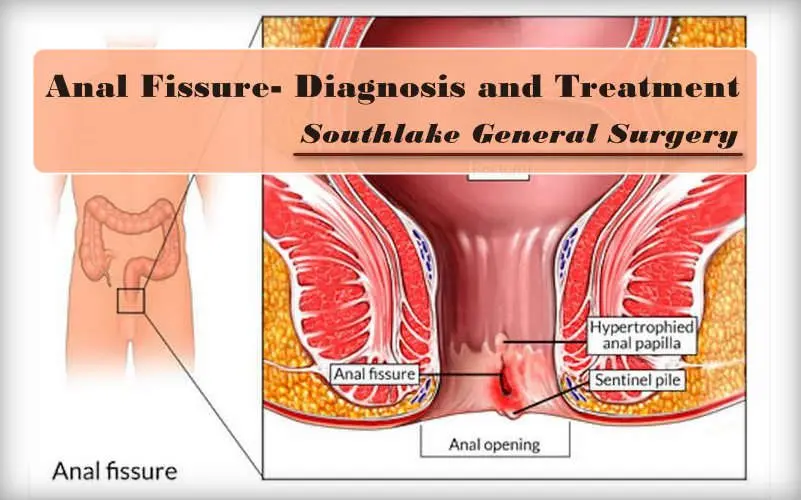 Medical treatments for anal fissure