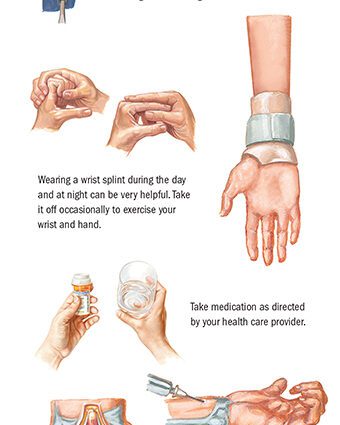 Medical treatments for carpal tunnel syndrome