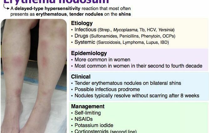 Medical treatments for erythema nodosum