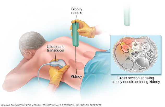 Medical treatments for kidney failure
