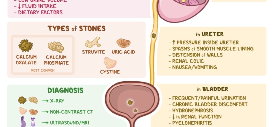 Medical treatments for kidney stones (renal lithiasis)