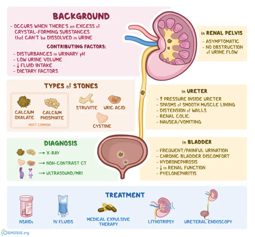 List 98+ Pictures treatment for a nephrolith lodged in the ureter Superb